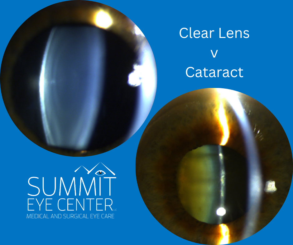Clear Lens v Cataract