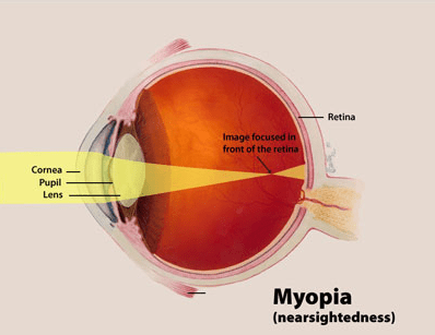 Myopia