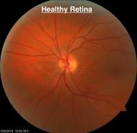 healthy retina