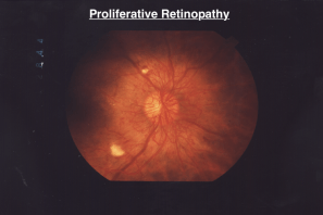 retina with proliferative retinopathy