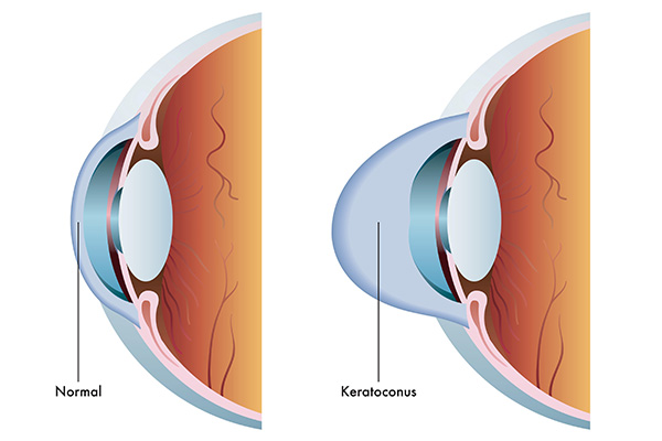 Keratoconus and Corneal Cross Linking