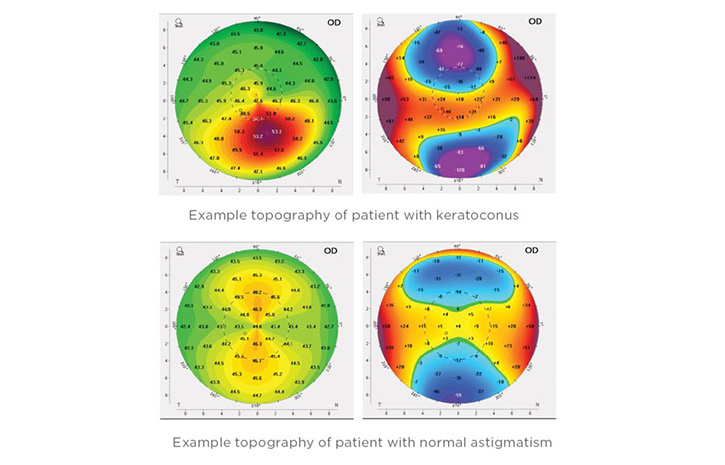 Symptoms of Keratoconus