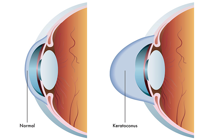 What is Keratoconus?